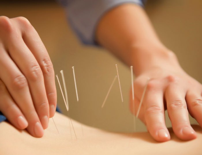 Иглорефлексотерапия - Пансионат «Фрегат»